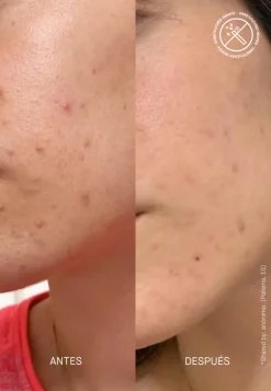 Best Spezialpflege·Akne